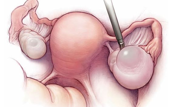 Read more about the article Endoscopic Surgeries