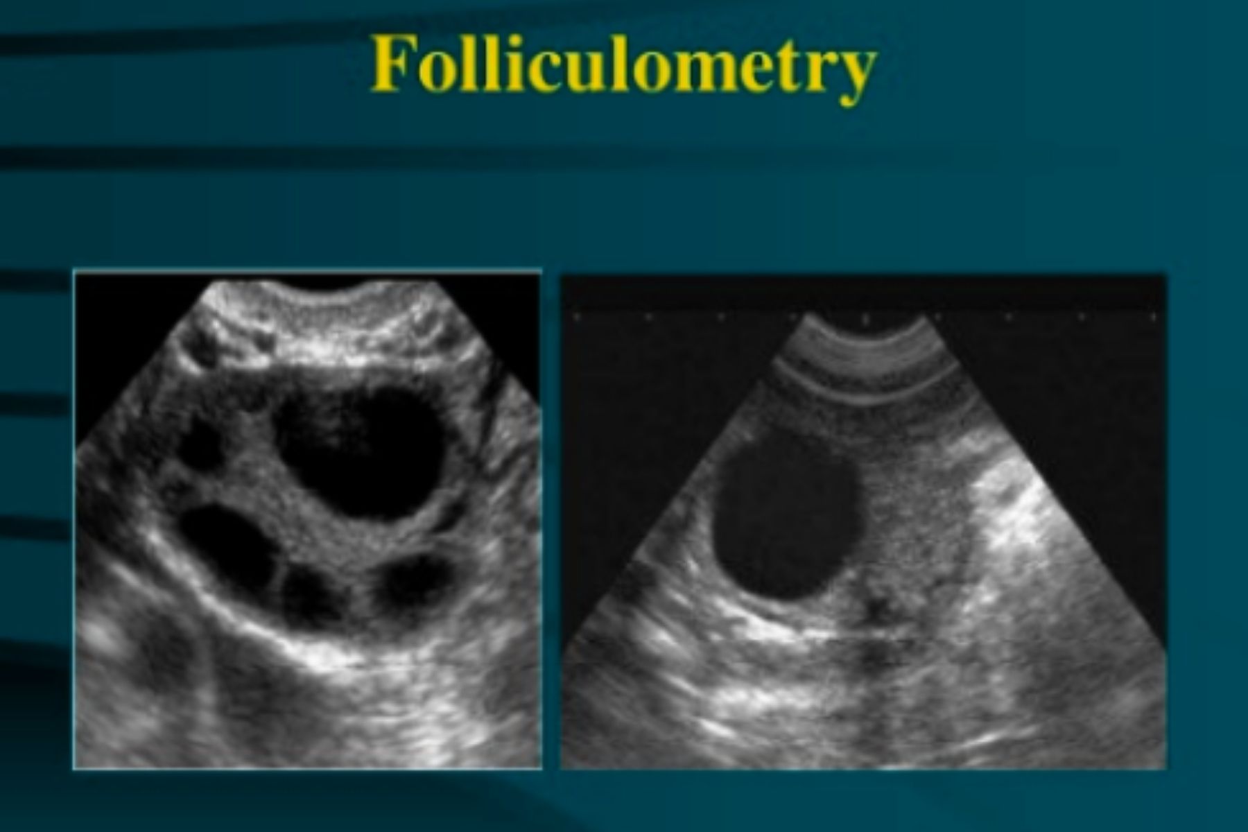 Read more about the article What is Folliculometry?
